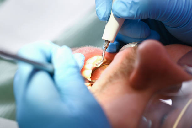 Best Emergency Wisdom Teeth Removal in Mason, MI